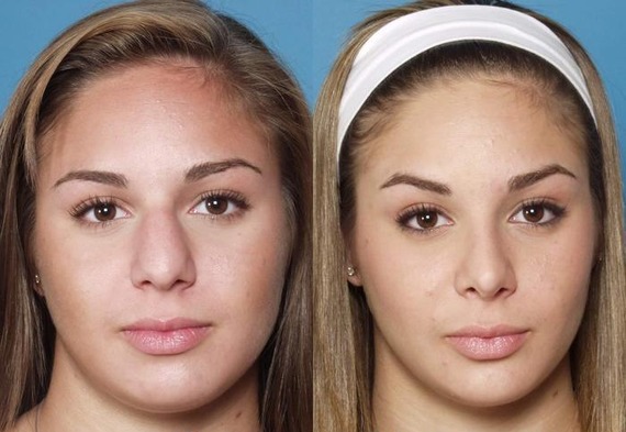 plastichna-operaciq-nosa