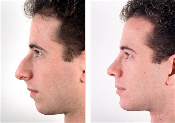 rinoplastika